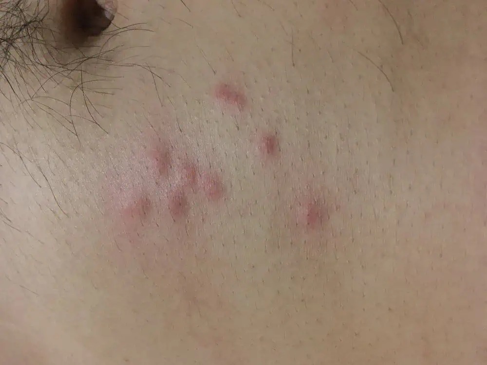 Bed bug bites